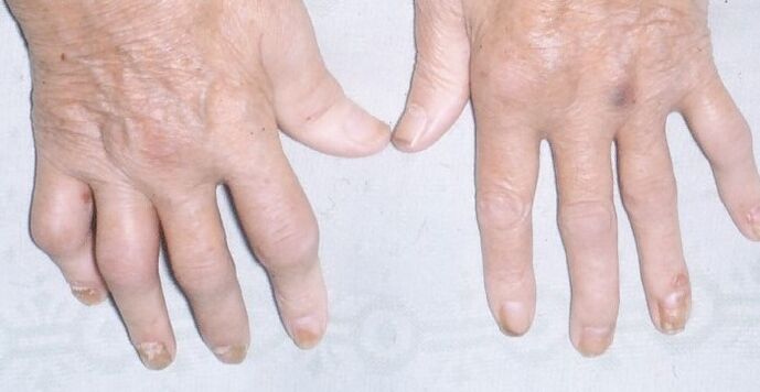 arthropathische Psoriasis in den Händen