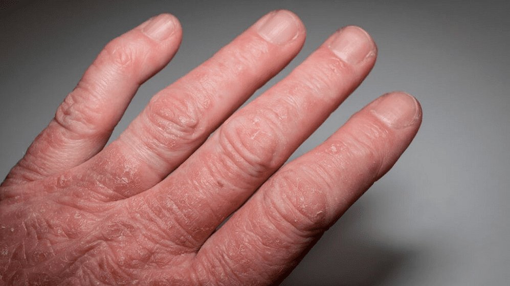 Psoriasis-Arthritis der Hände