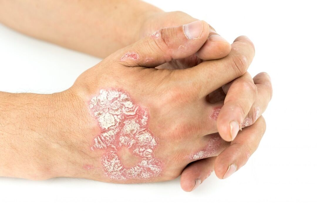 wie Psoriasis an den Händen aussieht
