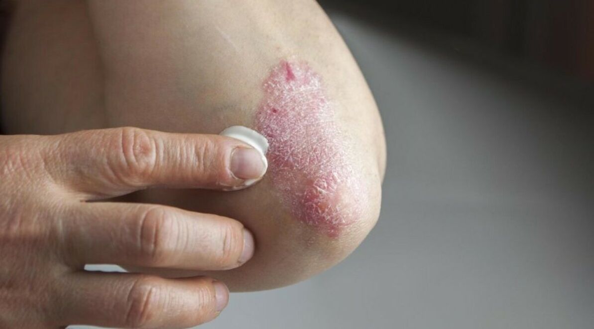 Psoriasis, die die Haut betrifft und zu deren Behandlung Salben verwendet werden