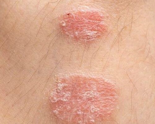 Aussehen von Psoriasis -Platten