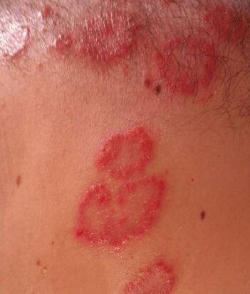 Psoriasis -Mahlzeiten
