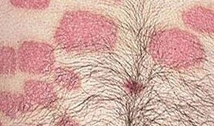 Weitere rosa Formationen am Bauch