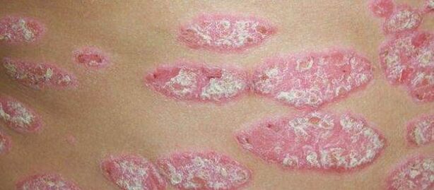 Die fortschreitende Phase der Psoriasis