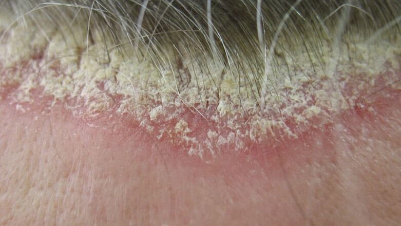 Psoriasis der Kopfhaut
