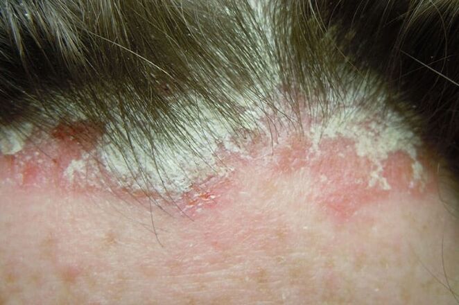 Psoriasis fängt den gesamten haarigen Teil des Kopfes ein
