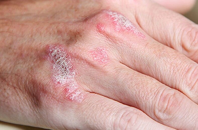 Psoriasis von Ladomaria-Contentuta