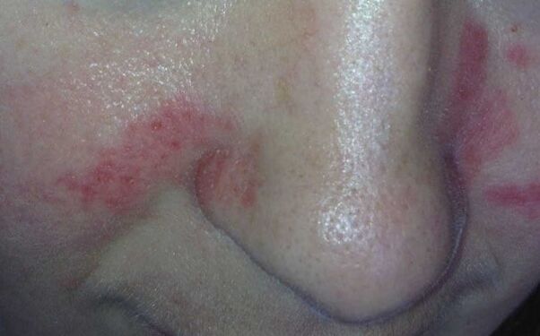 Symptome der Psoriasis im Gesicht