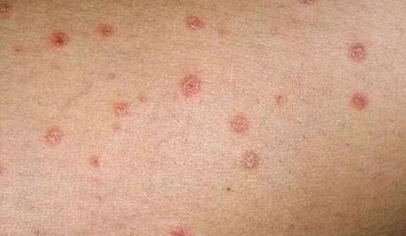 Die Anfangsphase der Psoriasis