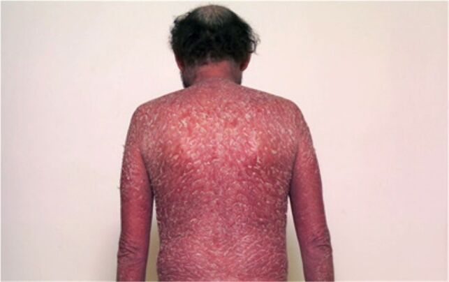 Die dritte Phase der Psoriasis
