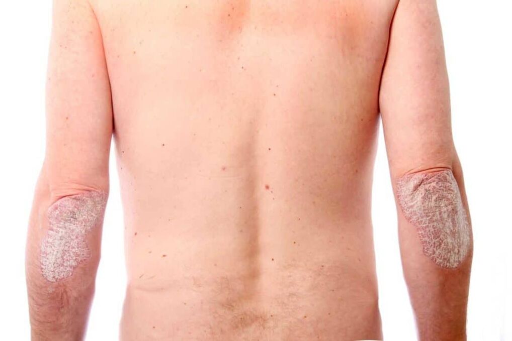 Die zweite Phase der Psoriasis
