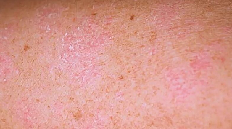 Das regressive Stadium der Psoriasis