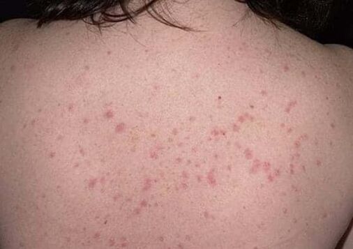 Die Anfangsphase der Psoriasis