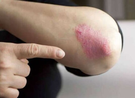 Die stationäre Phase der Psoriasis