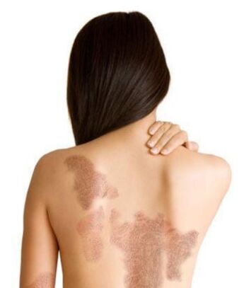 Psoriasis -Phase je nach Verletzungsbereich