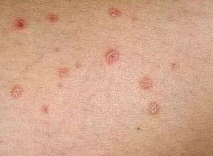 Psoriasis der Anfangsphase