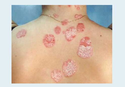 Gewöhnliche Psoriasis