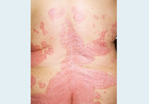 Psoriasis des hinteren Teils