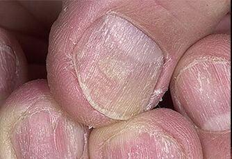 Nagel -Psoriasis