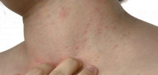 Psoriasis am Hals