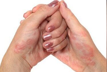 Psoriasis in den Händen