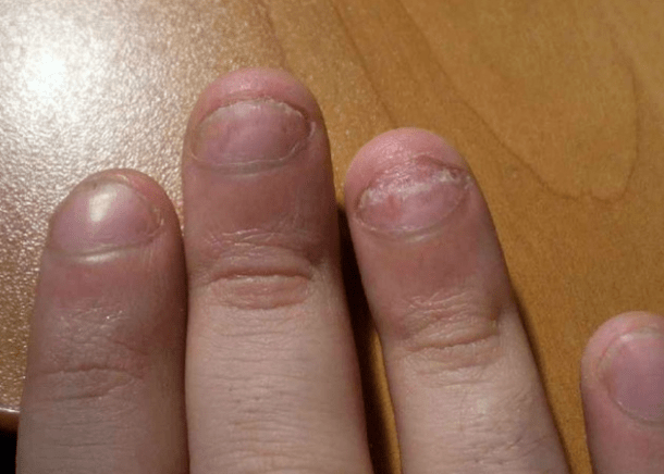 Nagel -Psoriasis