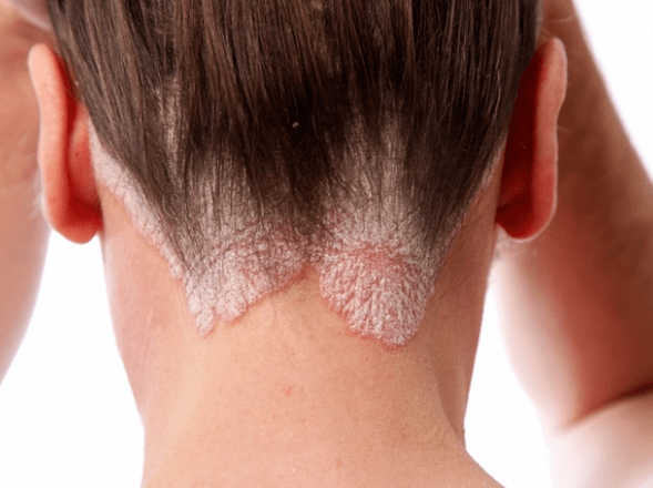 Psoriasis am Kopf