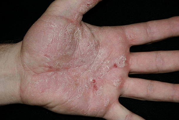 Psoriasis in den Händen