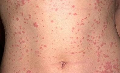Psoriasis am Körper