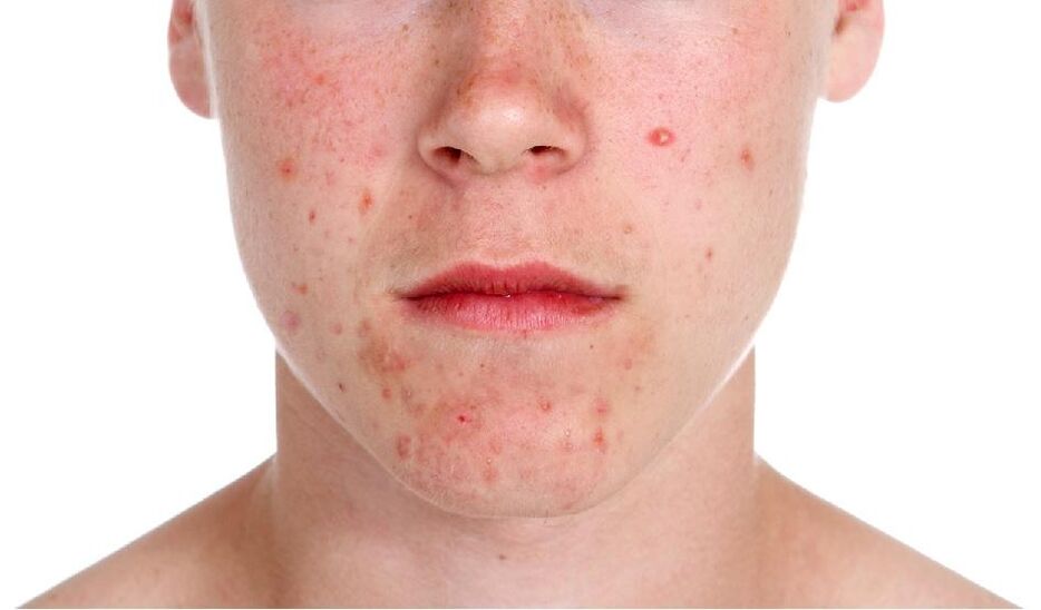 Psoriasis im Gesicht