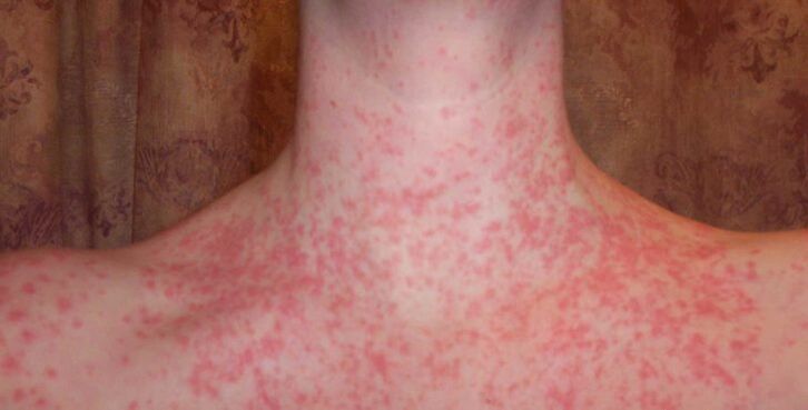 Psoriasis am Körper