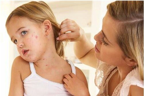 Fotos der Anfangsphase der Psoriasis