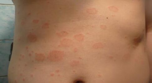 Psoriasis der Anfangsphase