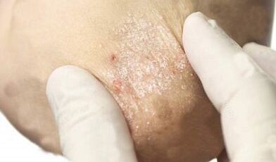 Behandlung der Psoriasis in der Abschwächungsphase