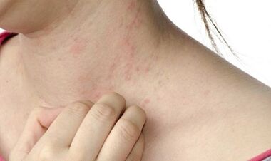 Behandlung fortgeschrittener Psoriasis