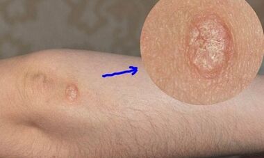 Entwicklungsstadien der Psoriasis