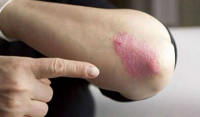stationäre Phase der Psoriasis-Entwicklung