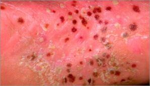 Pustelpsoriasis