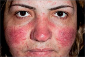 Seborrhoische Psoriasis