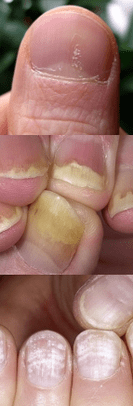 Psoriasis -Nagel - Anfangsphase