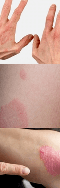 Psoriasis der Anfangsphase an den Händen