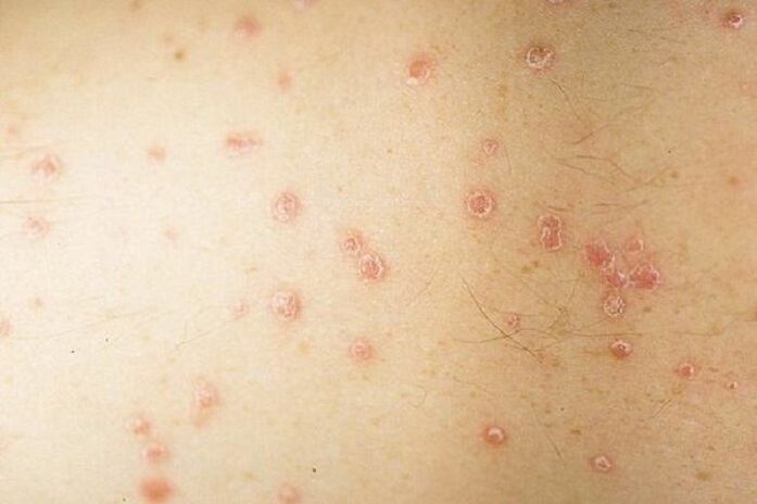 Erkennen Sie Psoriasis-Symptome