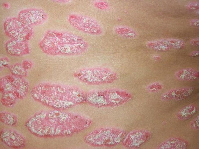 Plaque-Psoriasis