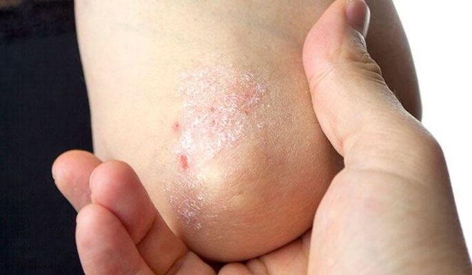 Symptome einer Psoriasis im Frühstadium
