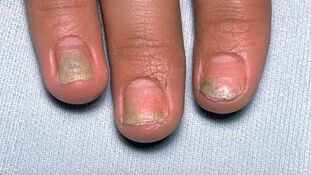 Ursachen für Psoriasis an den Nägeln